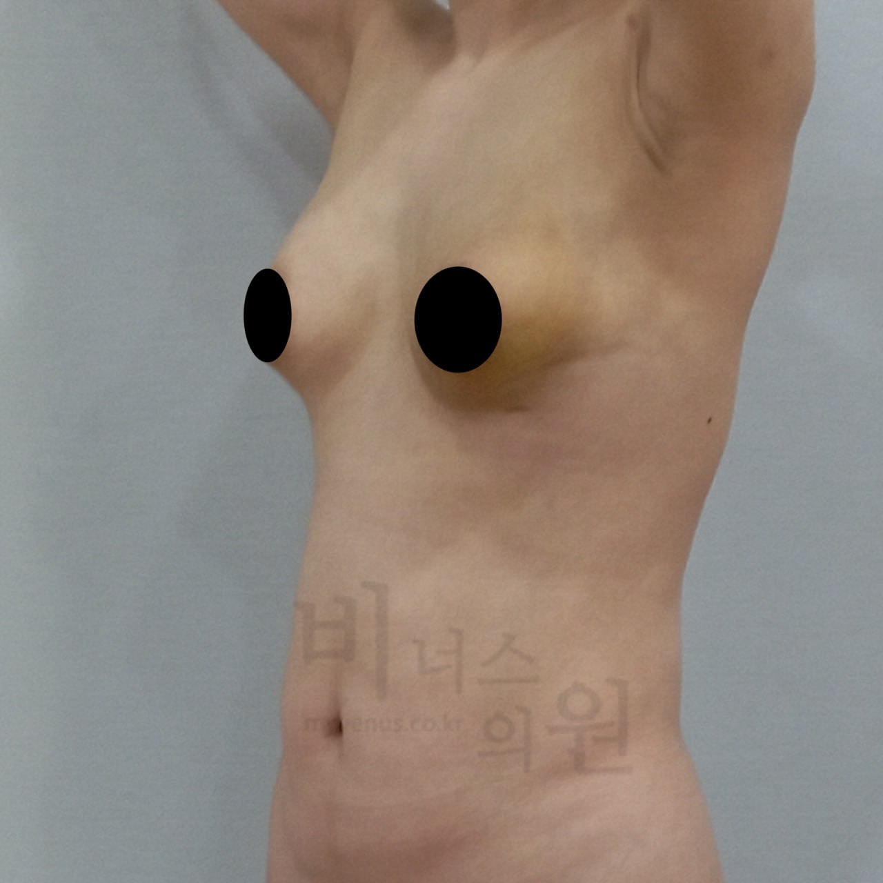 가슴축소 지방흡입 수술 후 사면 — 부천 비너스의원