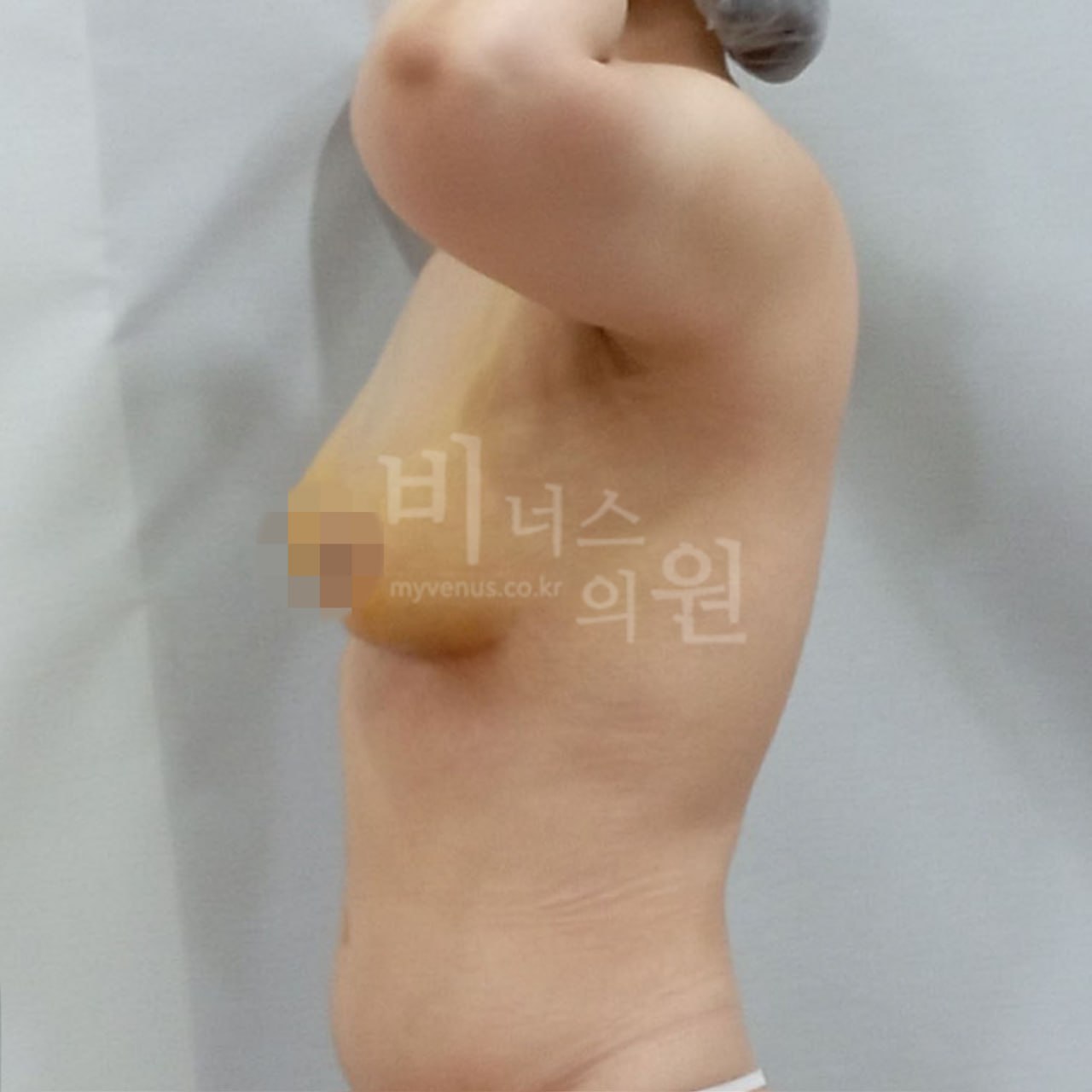가슴축소 지방흡입 수술 후 측면 — 부천 비너스의원