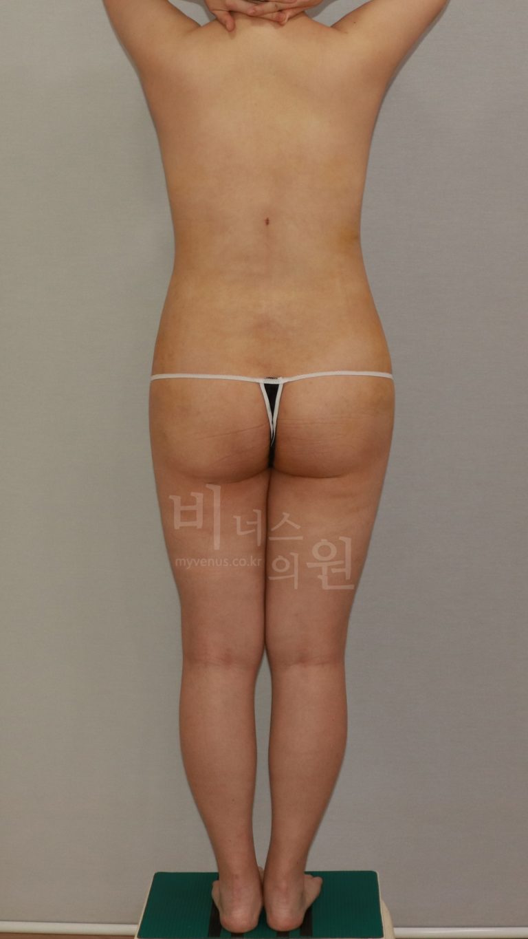 엉덩이축소, 지방흡입 단독 vs 지방이식 병행 — 상담에서 확인해야 할 차이와 비용 구조