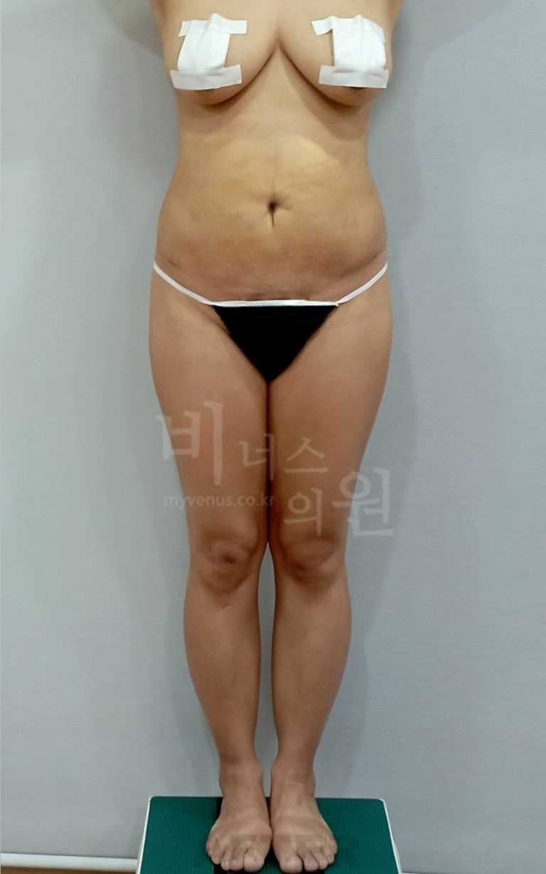 엉덩이축소 견적서의 ‘흡입량’과 ‘지방량’, 같은 숫자가 아닙니다 — 비용을 이해하는 기준