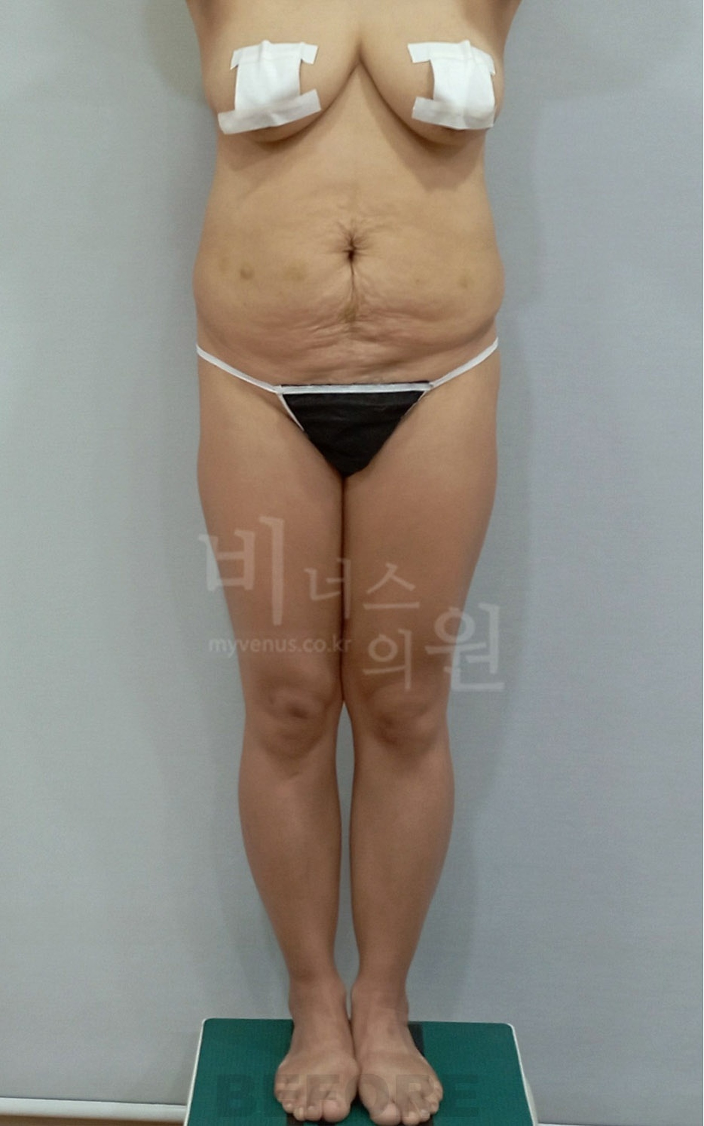 엉덩이축소 지방흡입 수술 전 정면