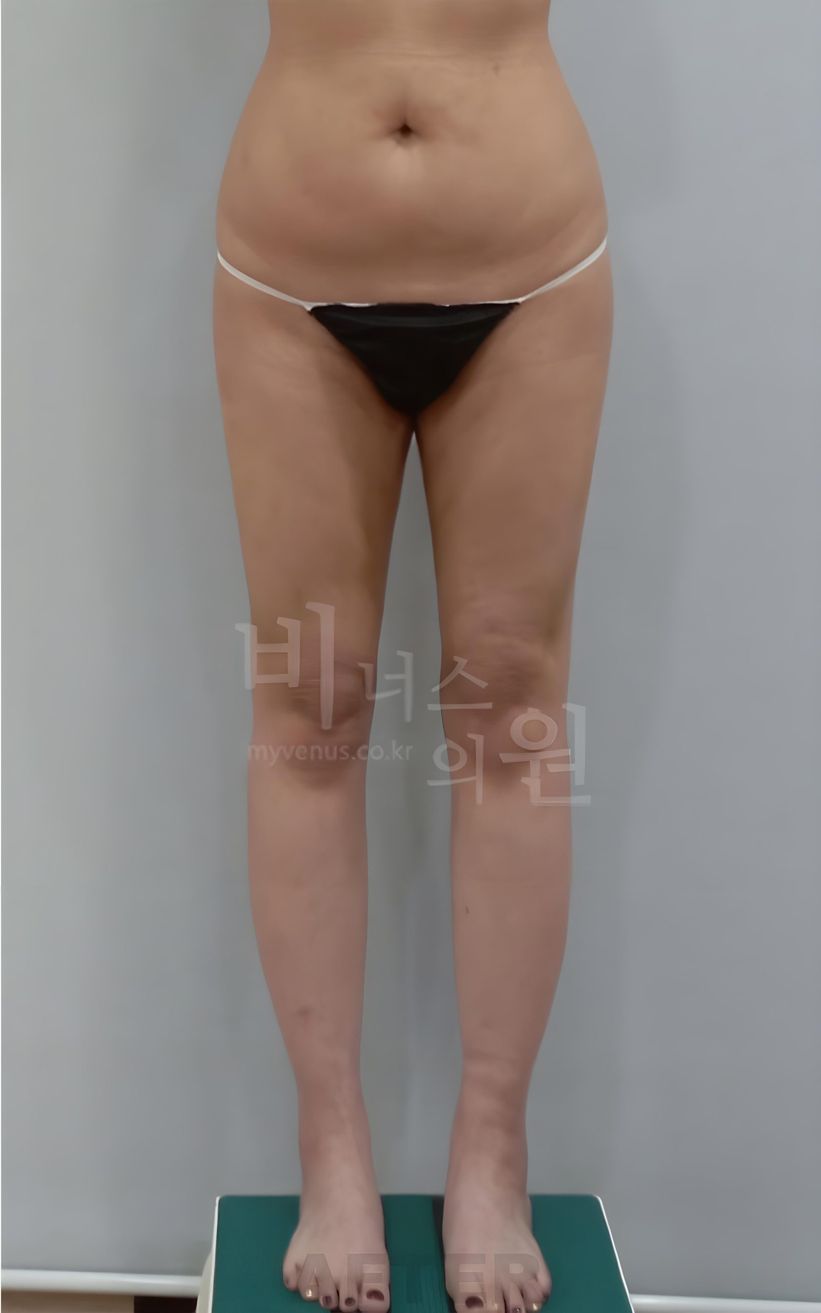 엉덩이 허벅지 재수술 지방흡입 수술 후 정면 사진