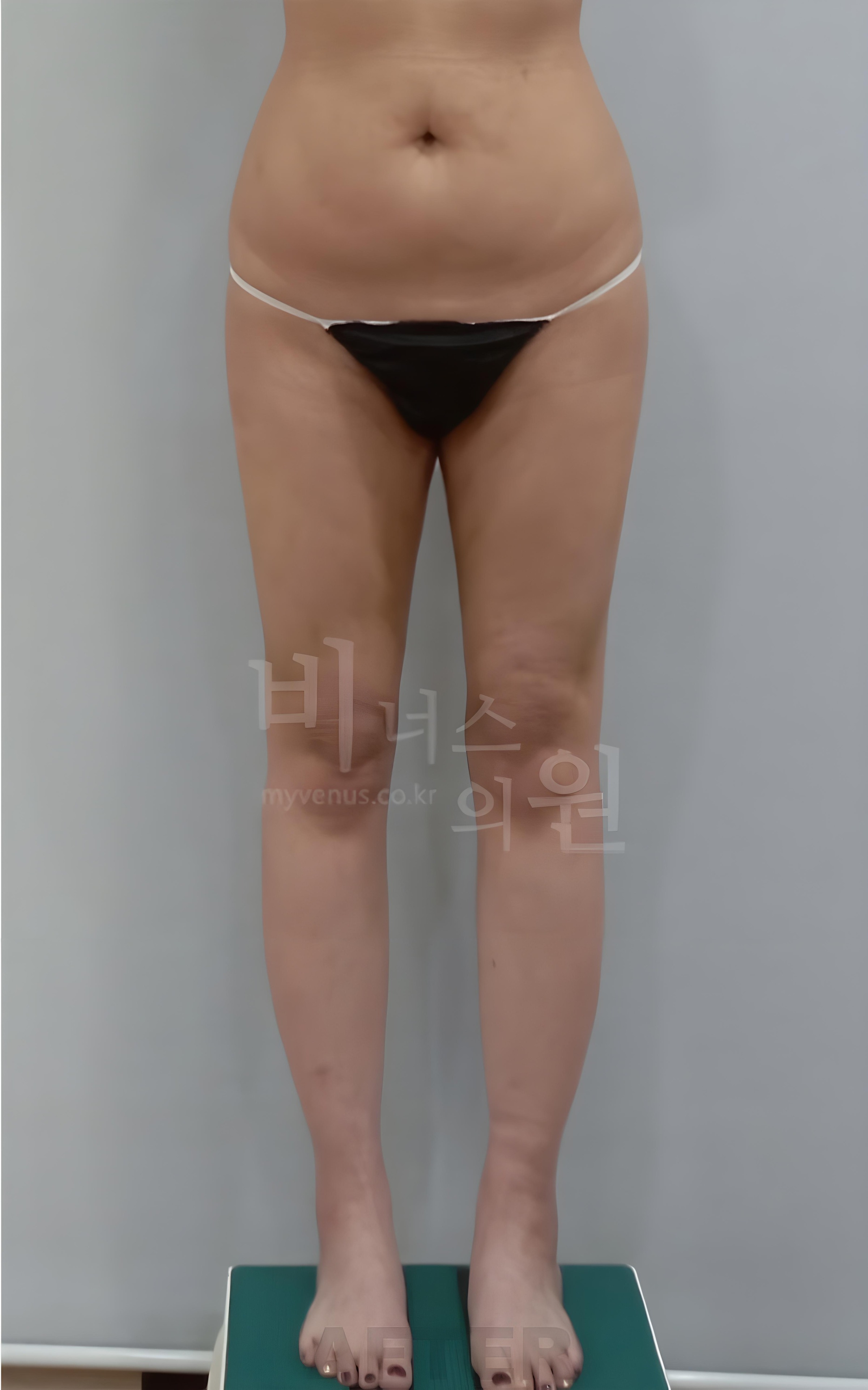 엉덩이축소 재수술 지방흡입 수술 후 정면 사진
