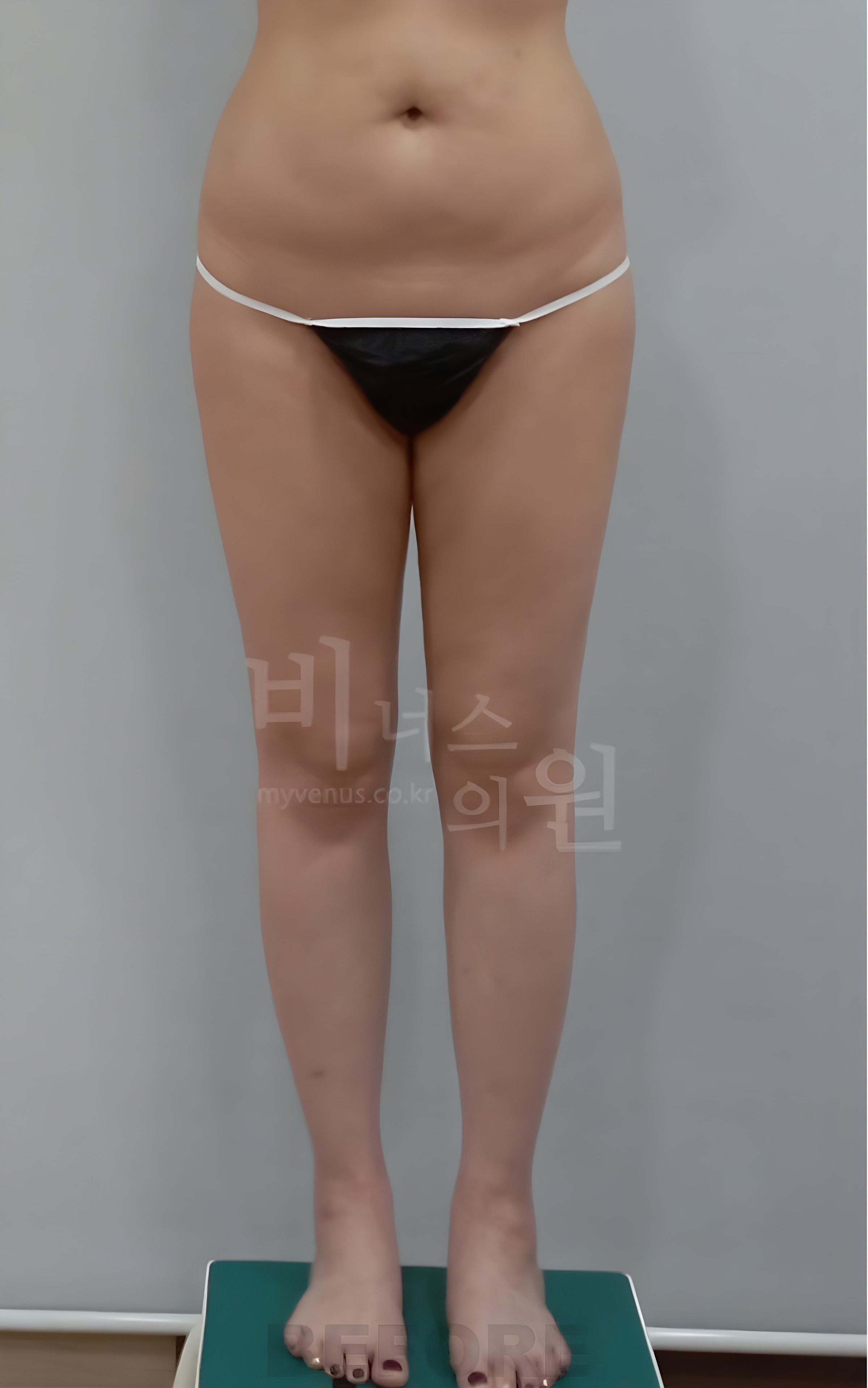 엉덩이축소 재수술 지방흡입 수술 전 정면 사진