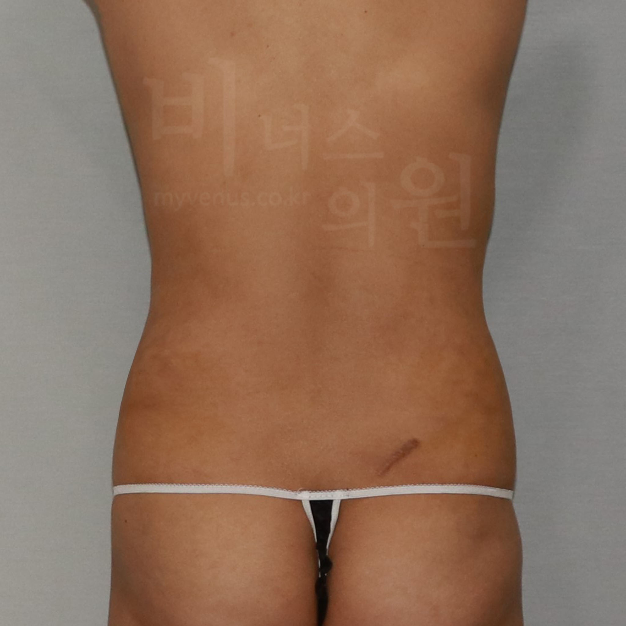 복부 지방흡입 수술 후 후면