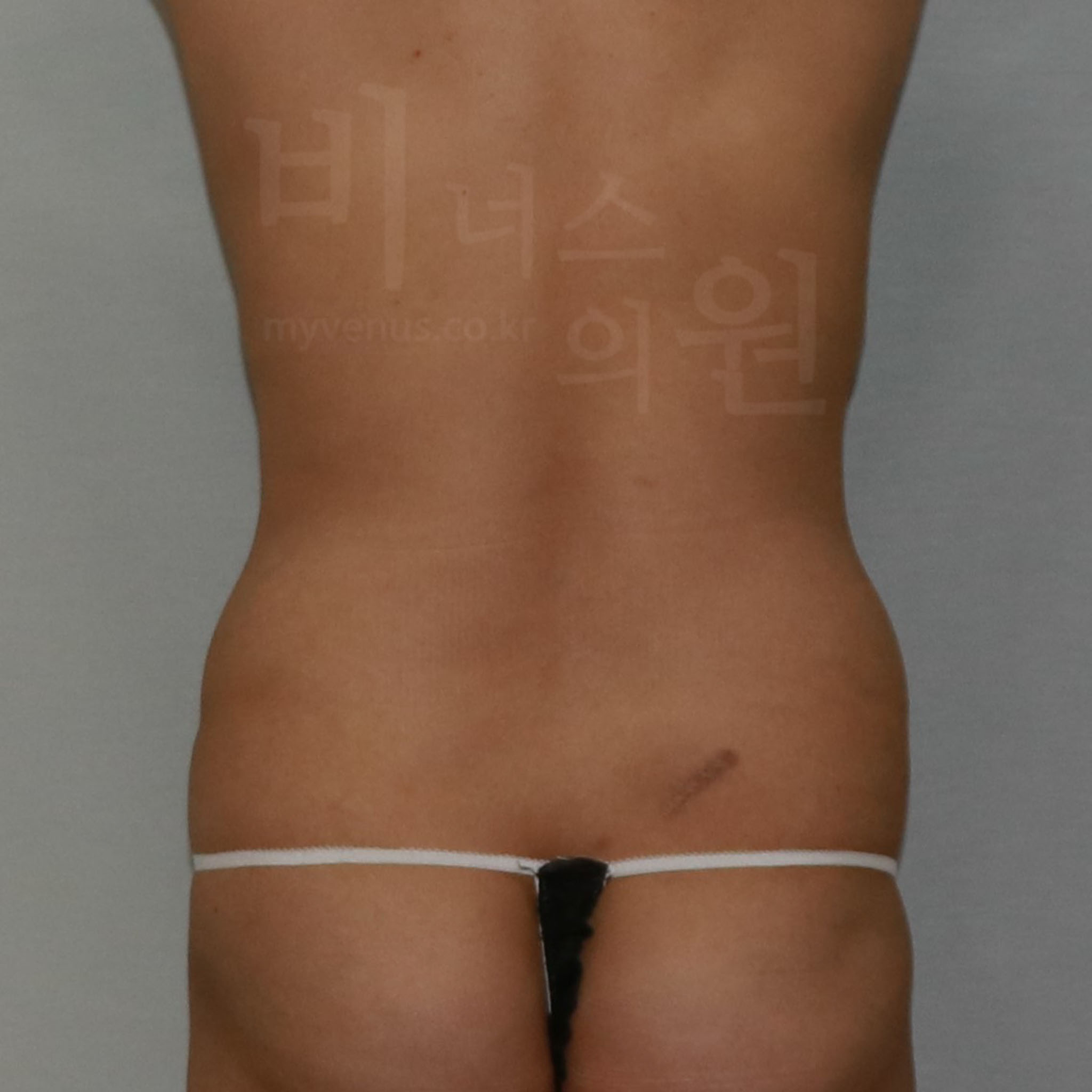 복부 지방흡입 수술 전 후면