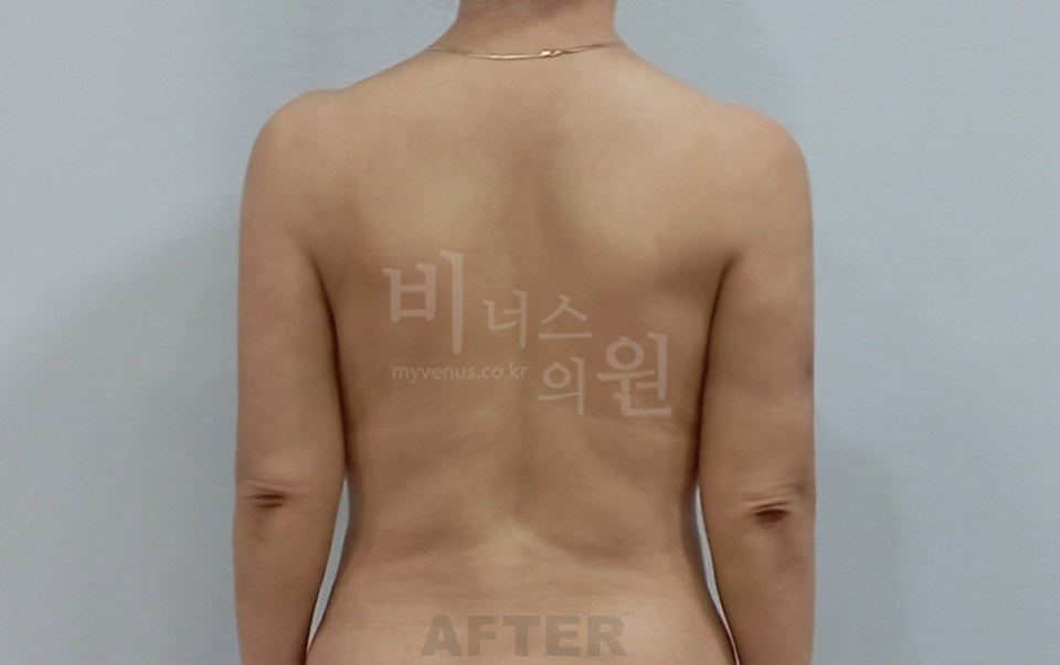 팔뚝 지방흡입 재수술 수술 후 1주 후면
