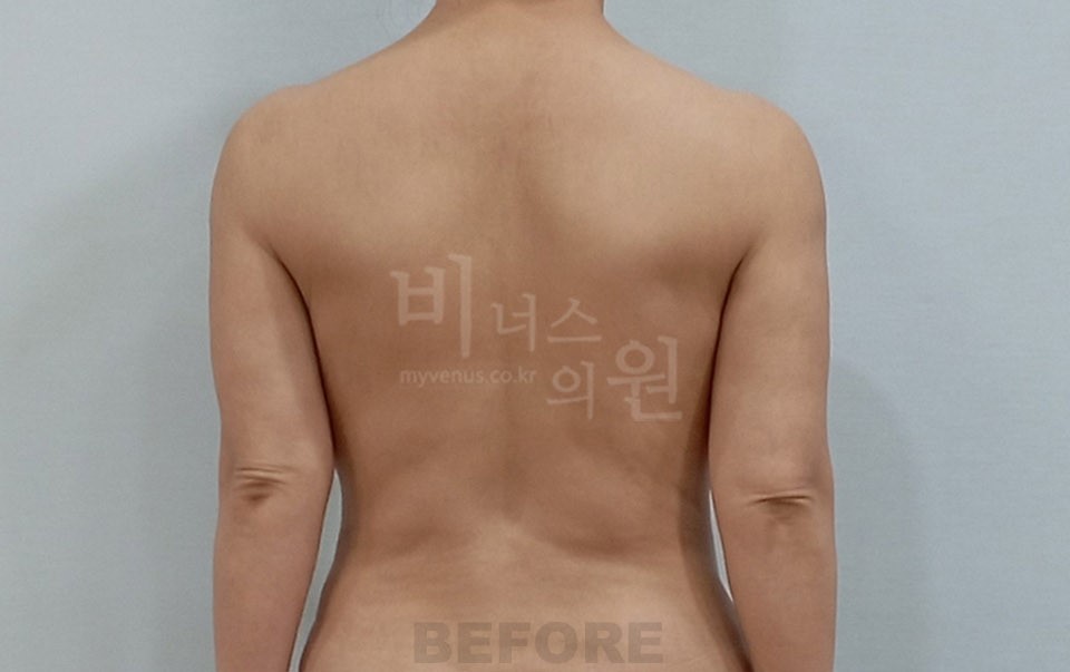 팔뚝 지방흡입 재수술 수술 전 후면