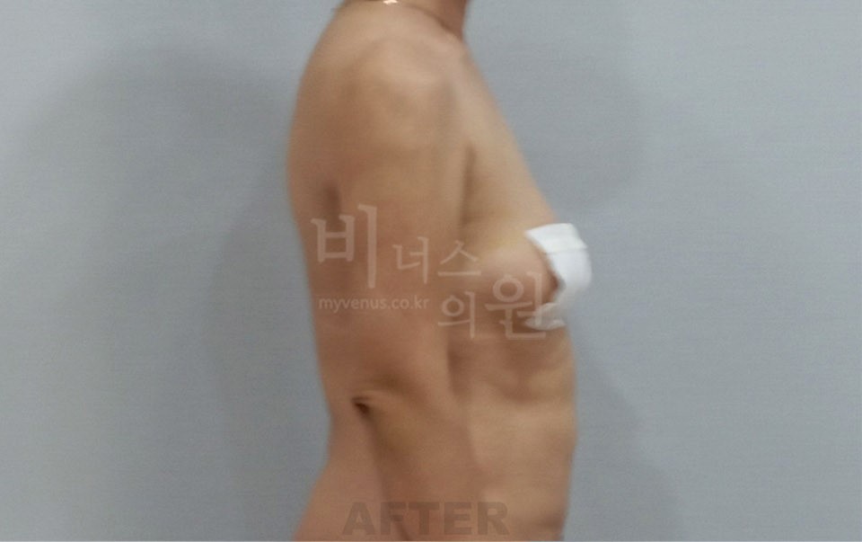 팔뚝 지방흡입 재수술 수술 후 1주 측면