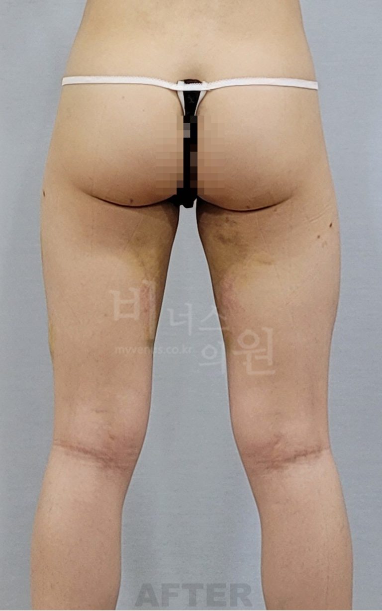 허벅지 지방흡입 비용, 무엇이 좌우할까? — 수술범위와 병원 선택 기준 가이드