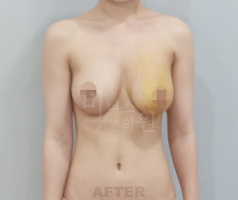 가슴축소 지방흡입, 상담 전에 알아두면 좋은 비용 판단 기준