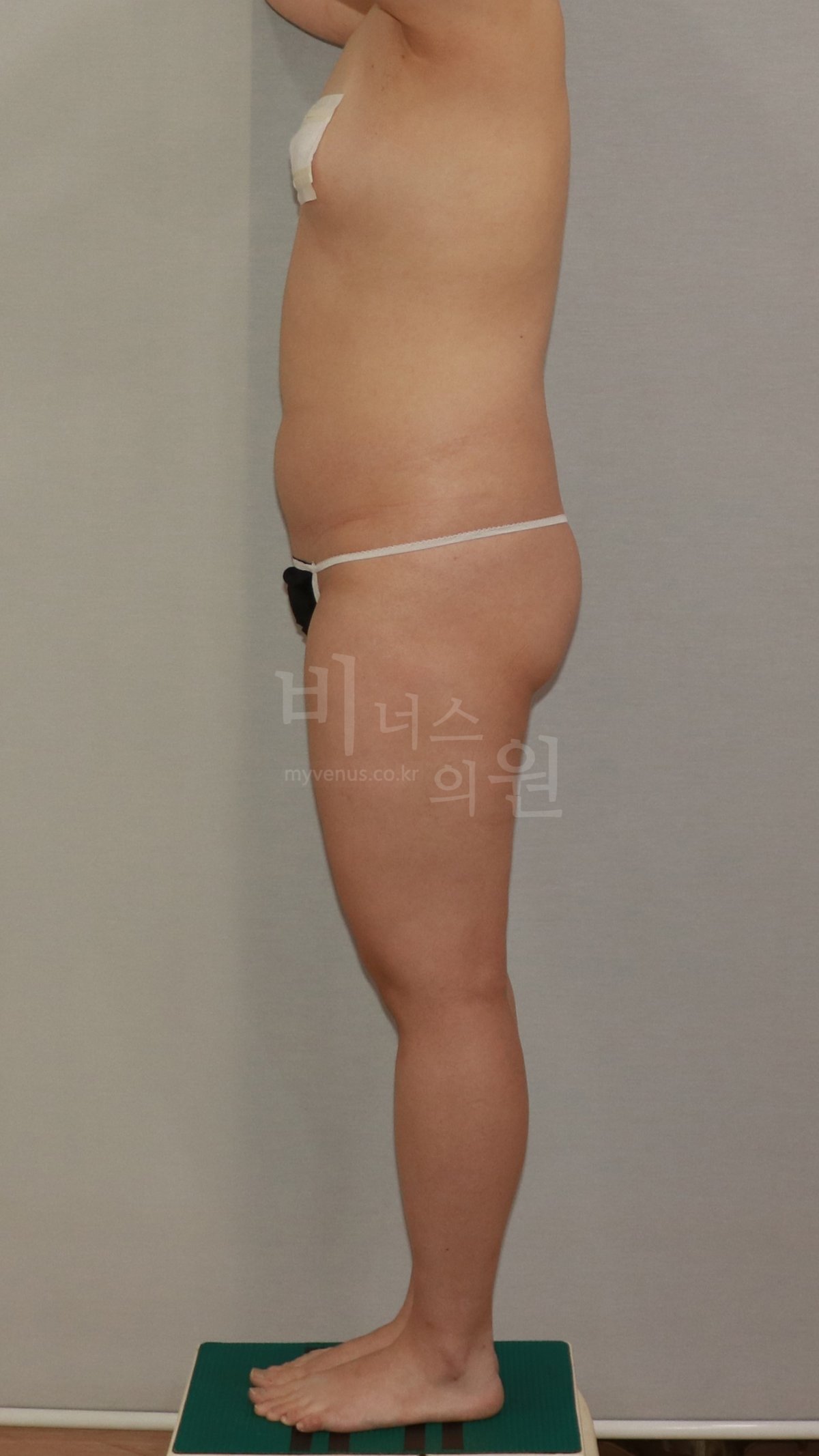 엉덩이축소 지방흡입 수술 전 측면