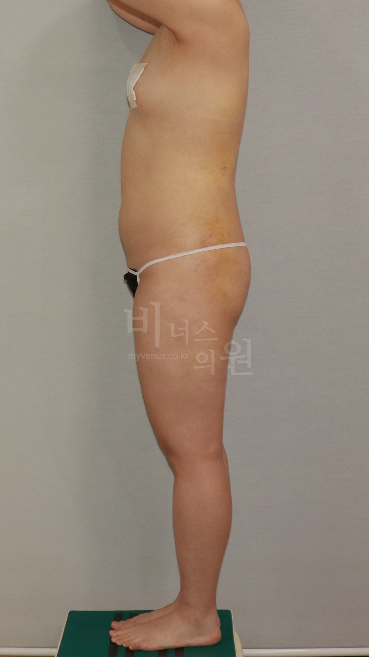 엉덩이축소 지방흡입 수술 후 1주 측면