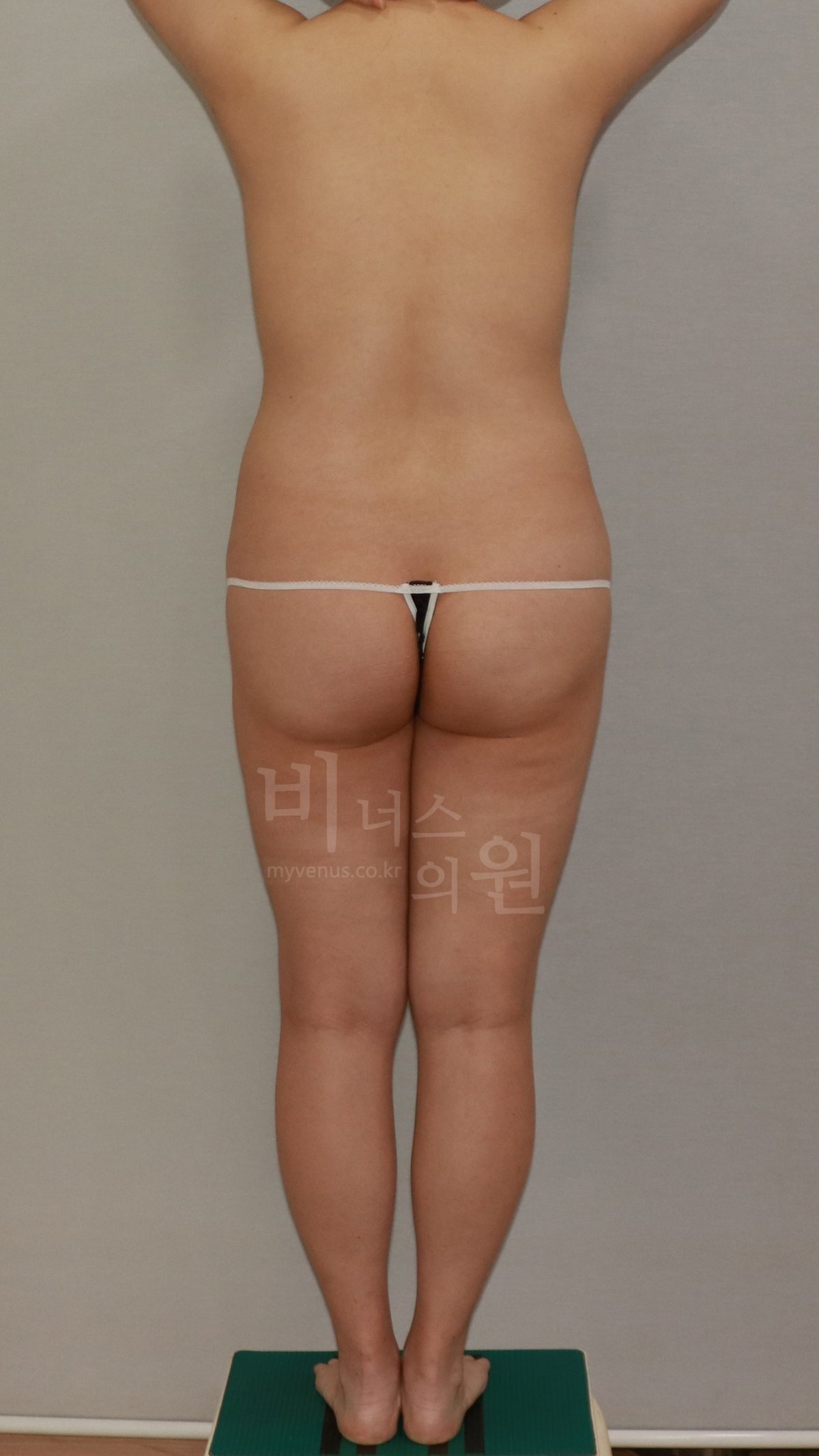 엉덩이축소 지방흡입 수술 전 후면