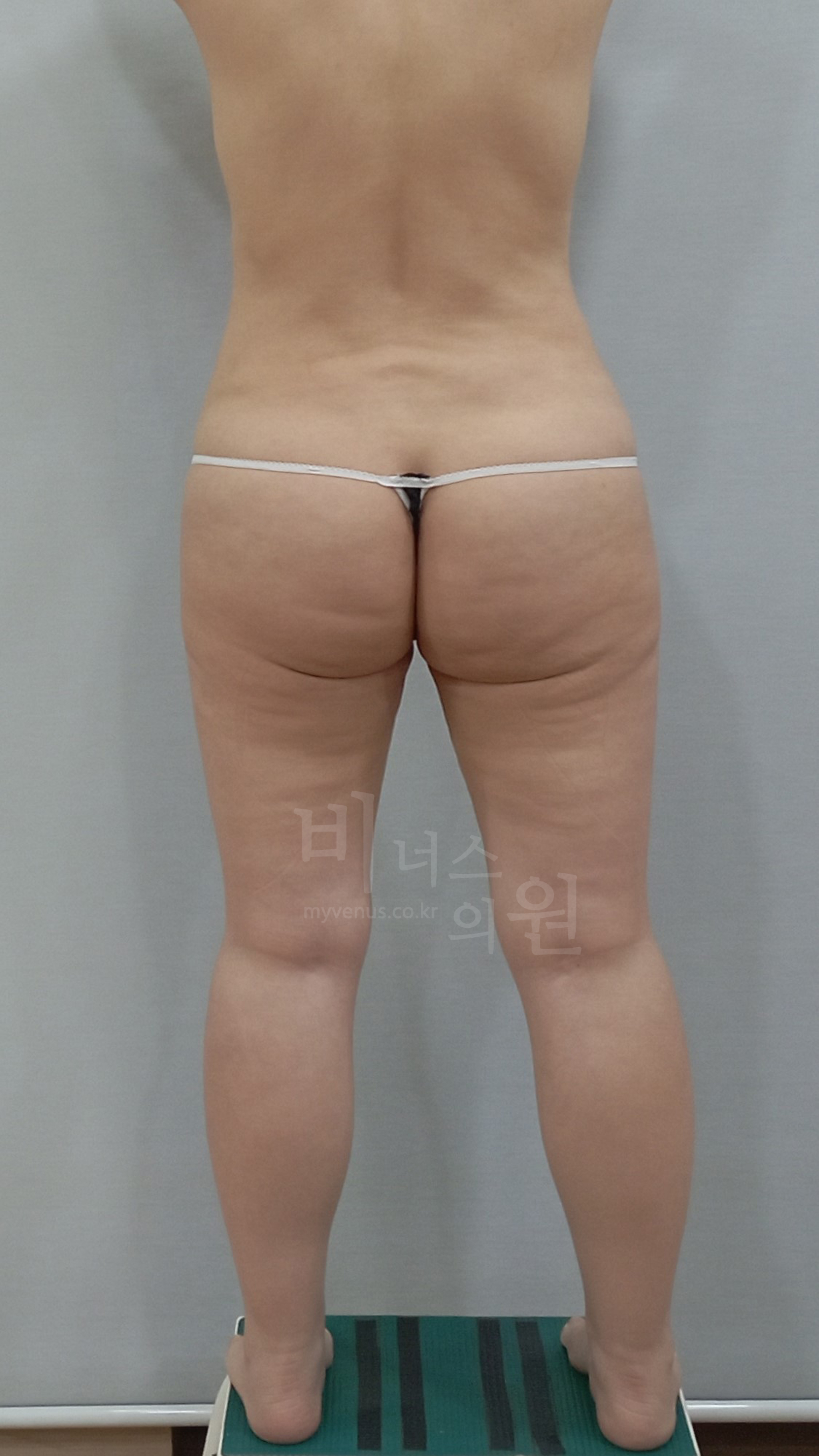 엉덩이축소 수술 전 후면③