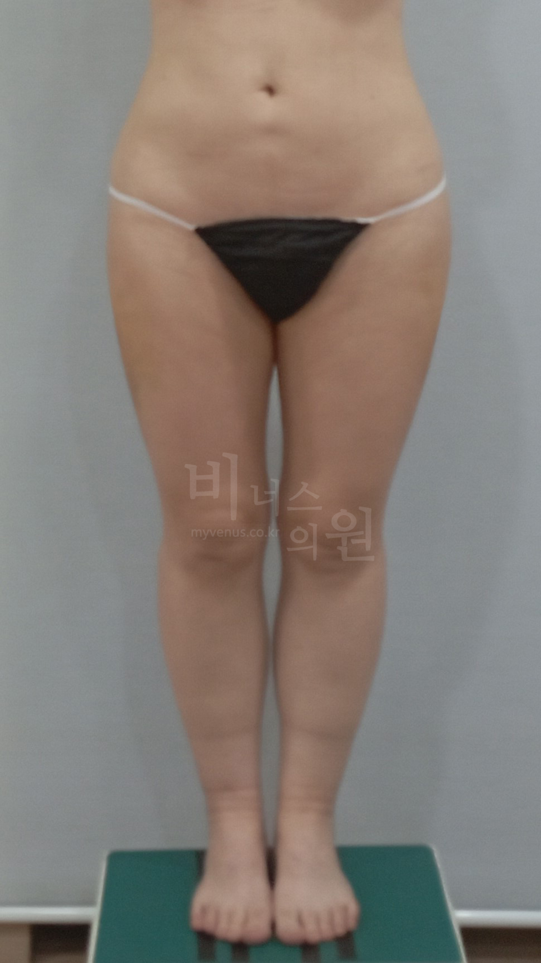 엉덩이축소 수술 후 정면 7일 경과