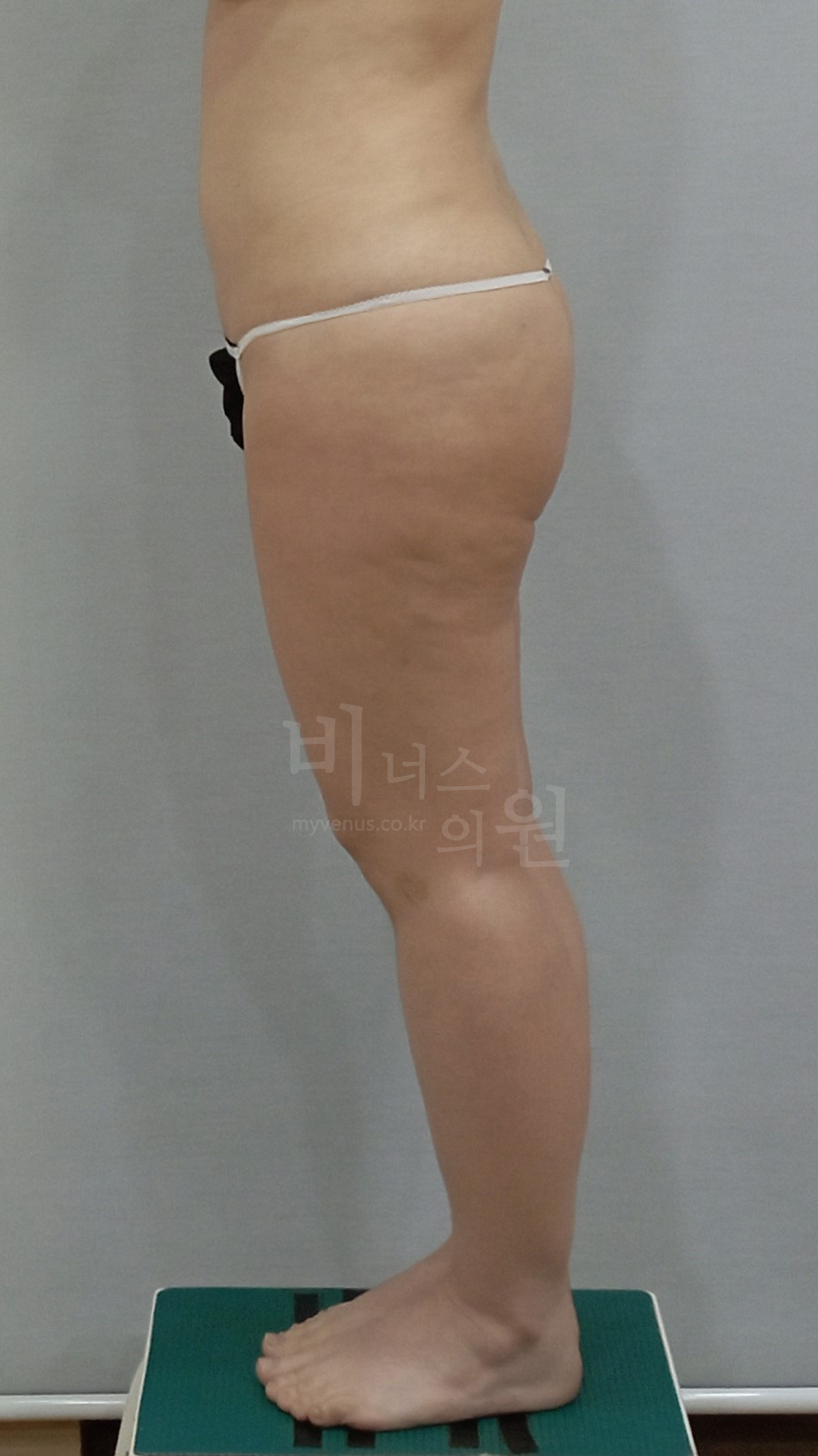 엉덩이축소 수술 전 측면