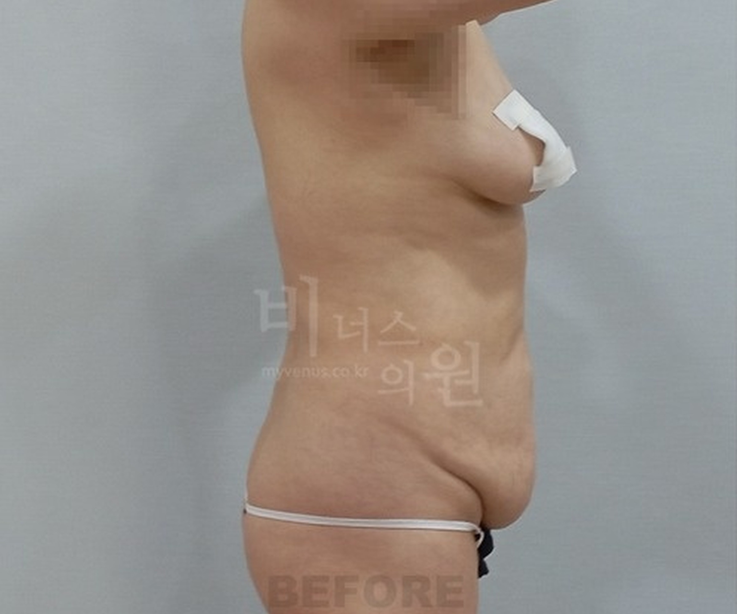 복부 지방흡입 수술 전 좌측면