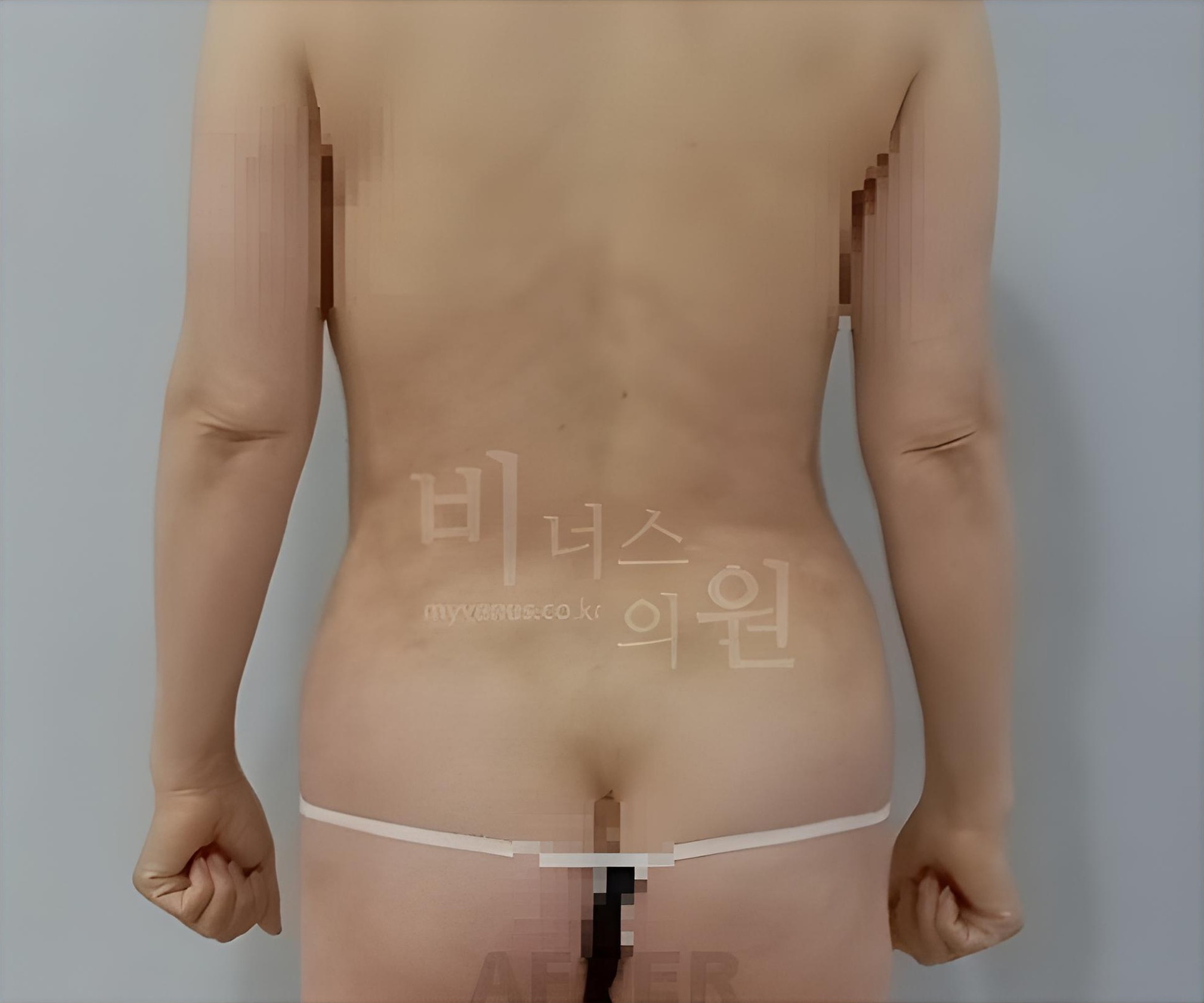 복부 지방흡입 수술 1주 후 후면