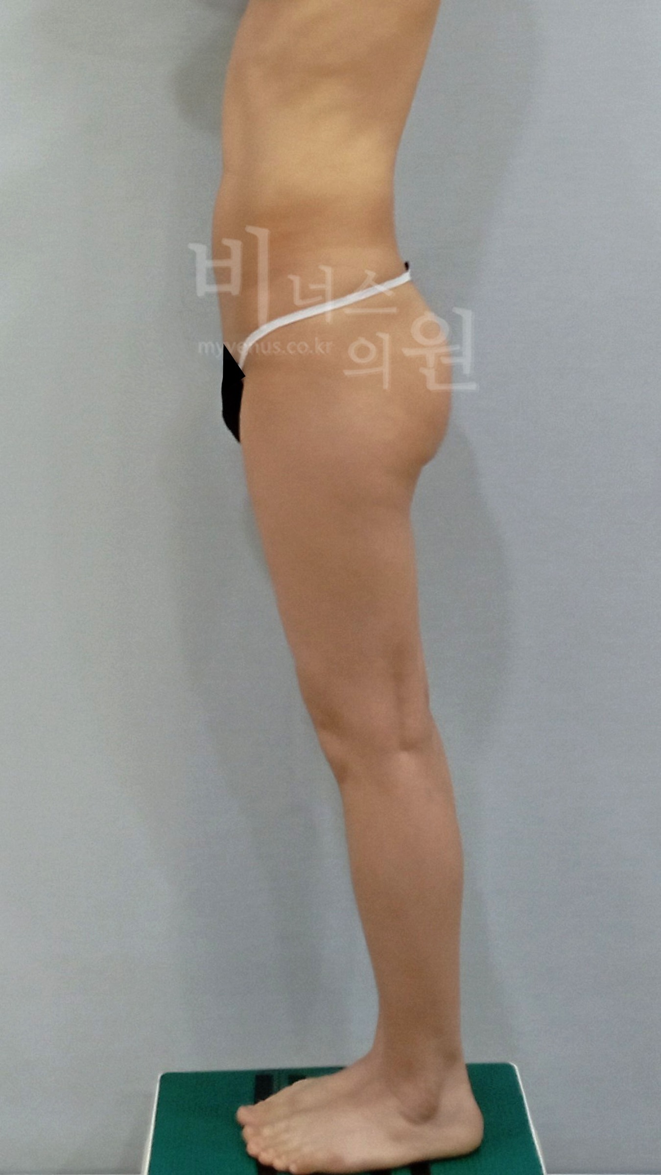 엉덩이 부위 수술 전 측면
