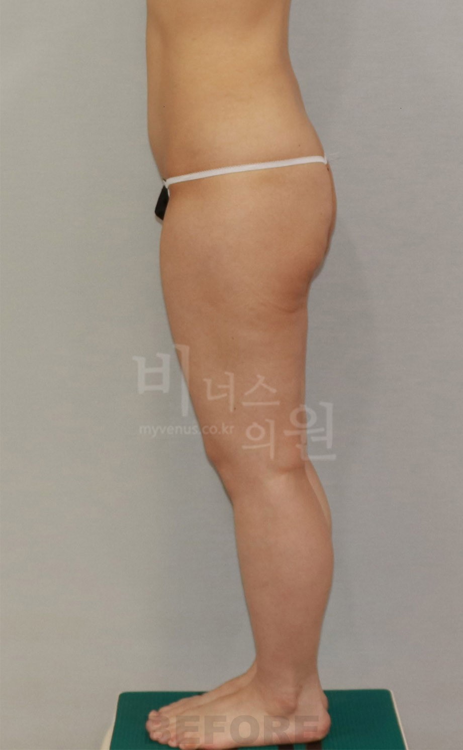 엉덩이 전후 비교 사진 - 측면 1 수술 전