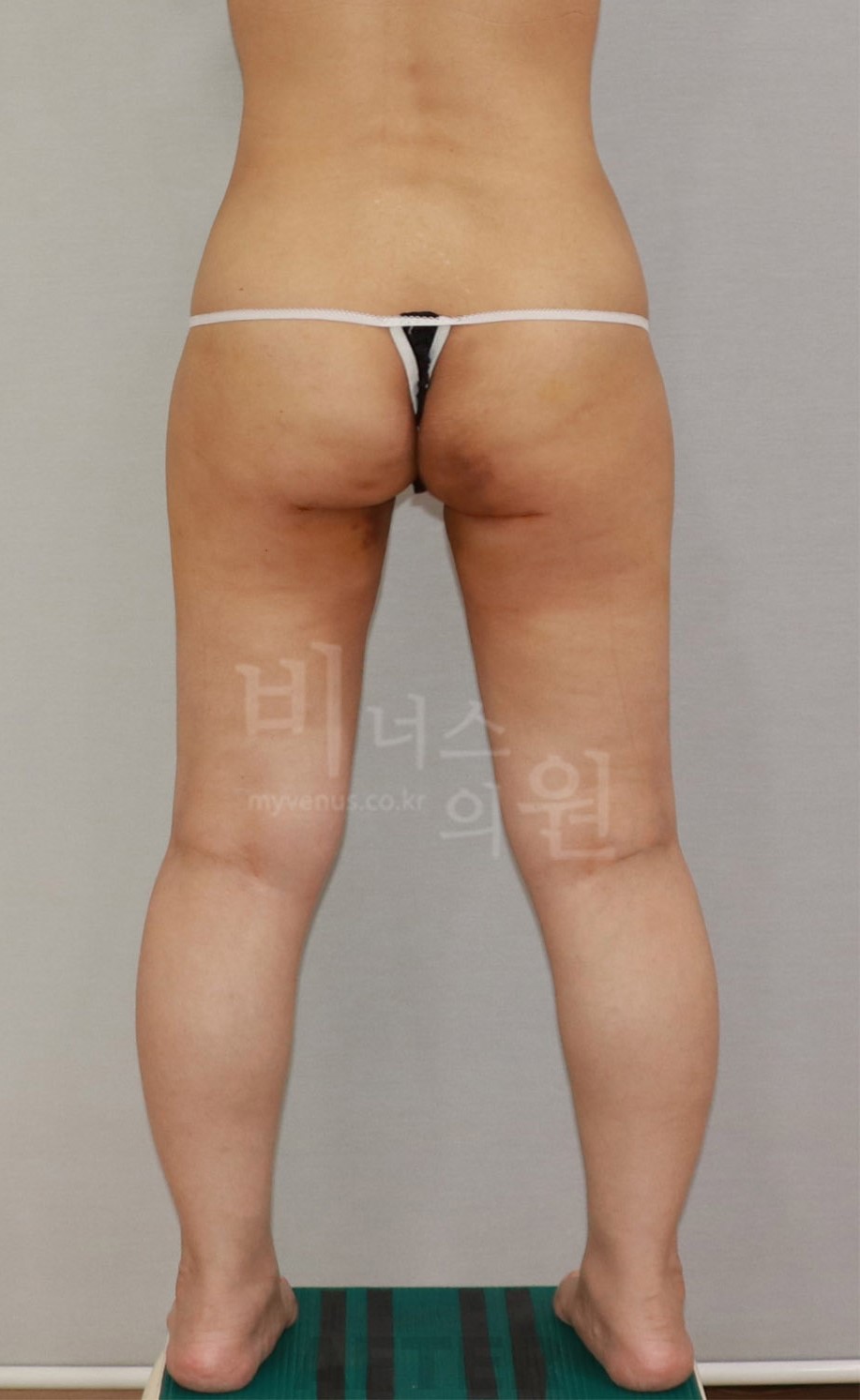 엉덩이 전후 비교 사진 - 후면 2 (발 벌림) 수술 후