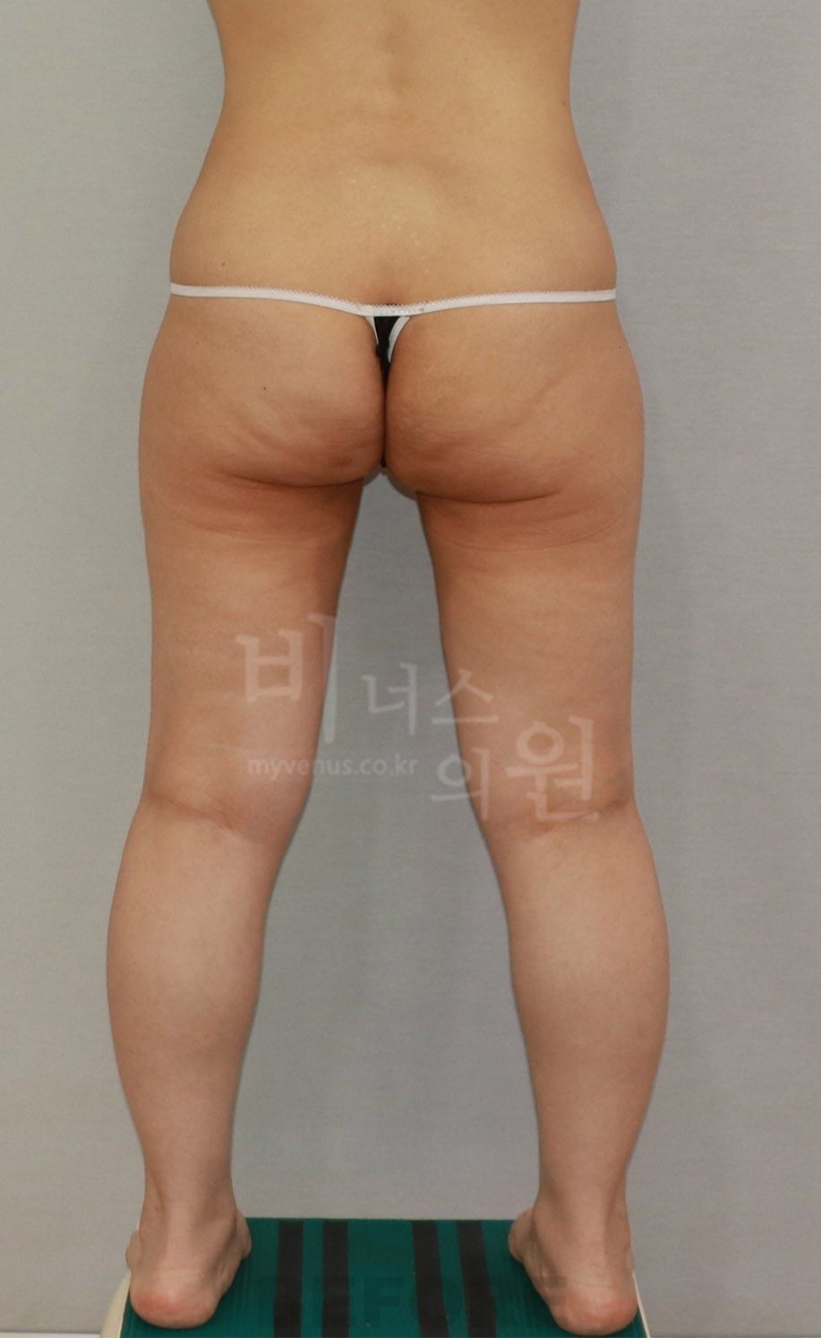 엉덩이 전후 비교 사진 - 후면 2 (발 벌림) 수술 전