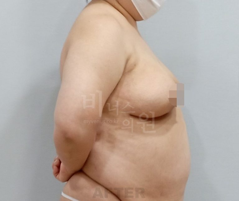 비너스의원 시술 후 측면 사진