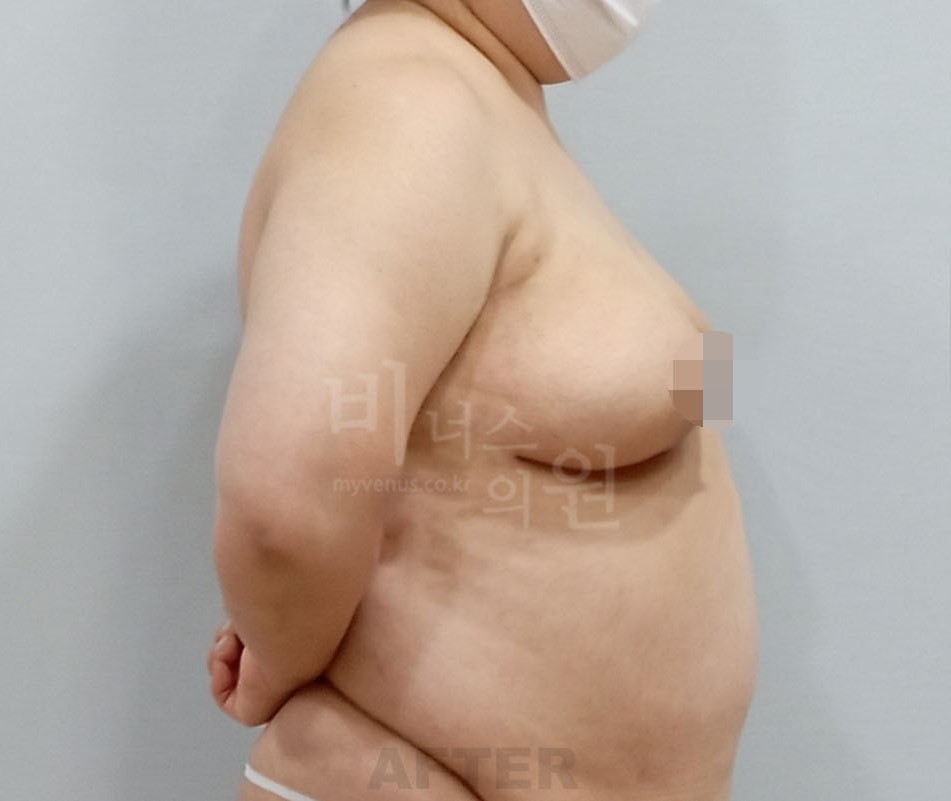 비너스의원 시술 후 측면 사진