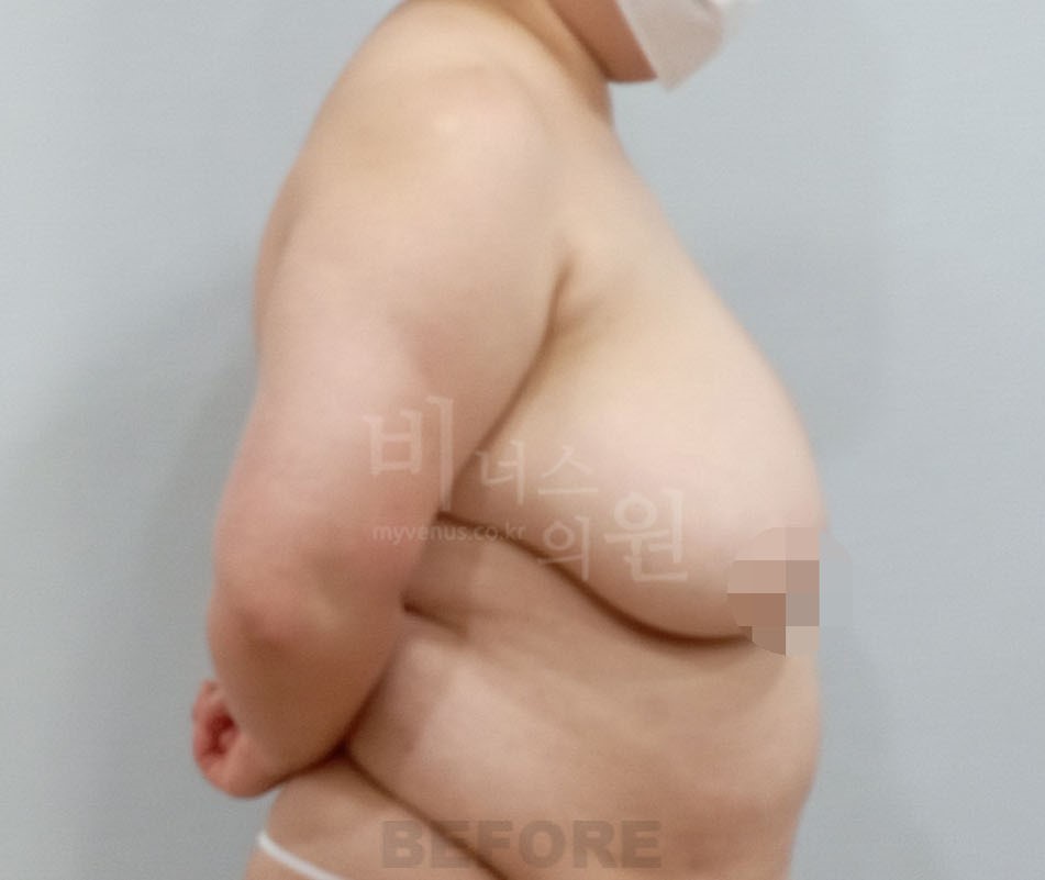 비너스의원 시술 전 측면 사진