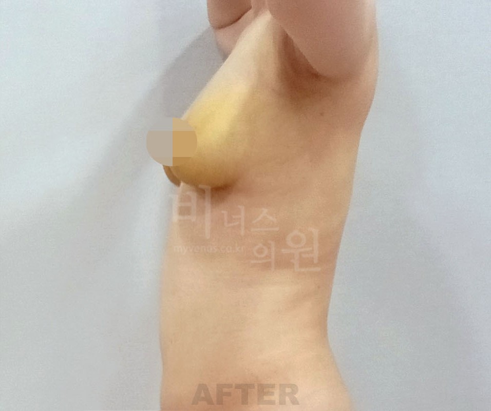 가슴 지방흡입 수술 후 경과 시점 우측면