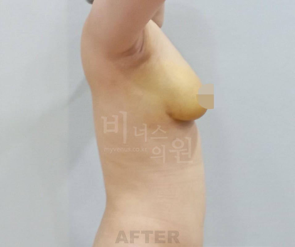 가슴 지방흡입 수술 후 경과 시점 좌측면