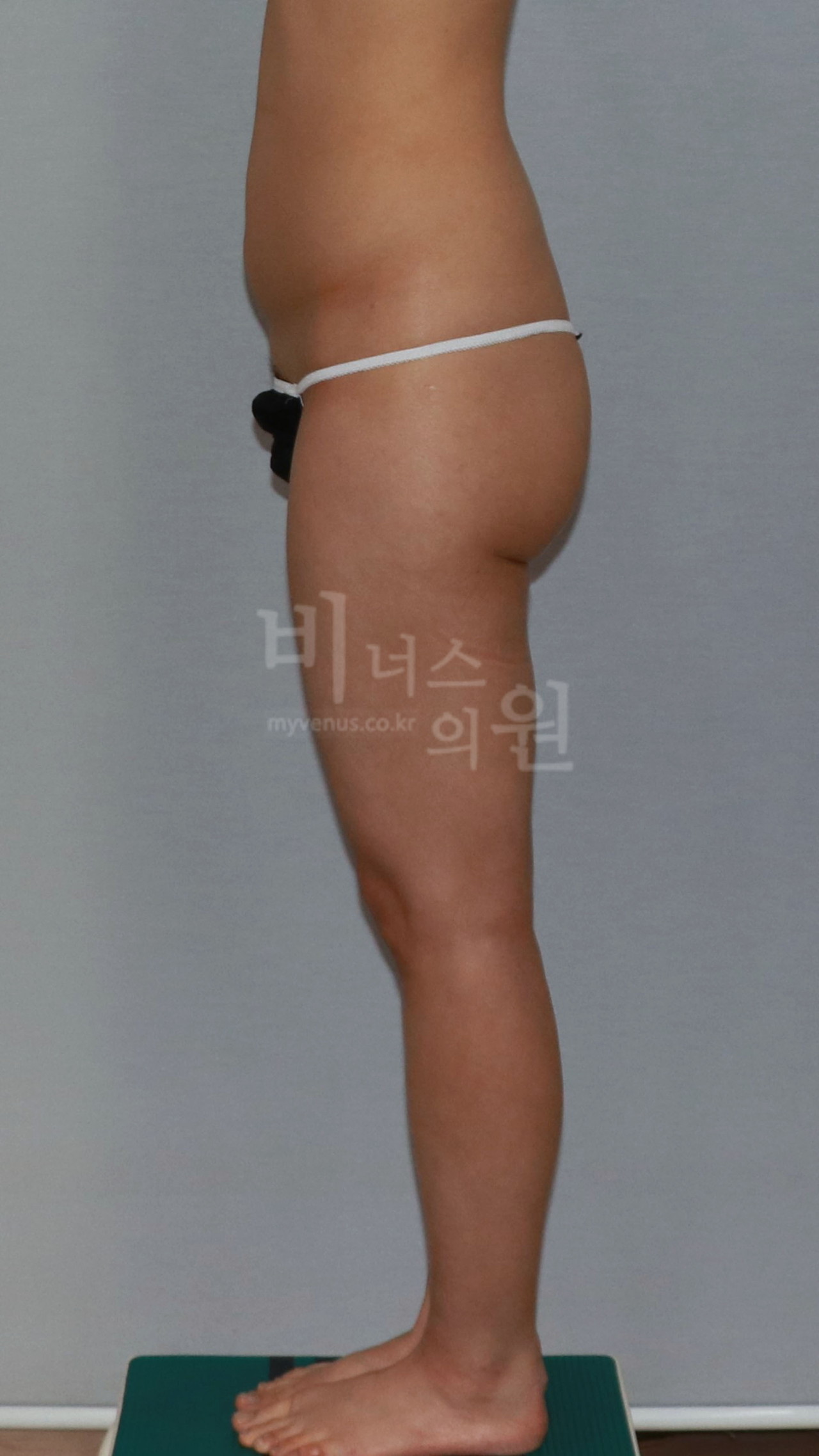엉덩이축소 지방흡입 수술 전 측면 사진