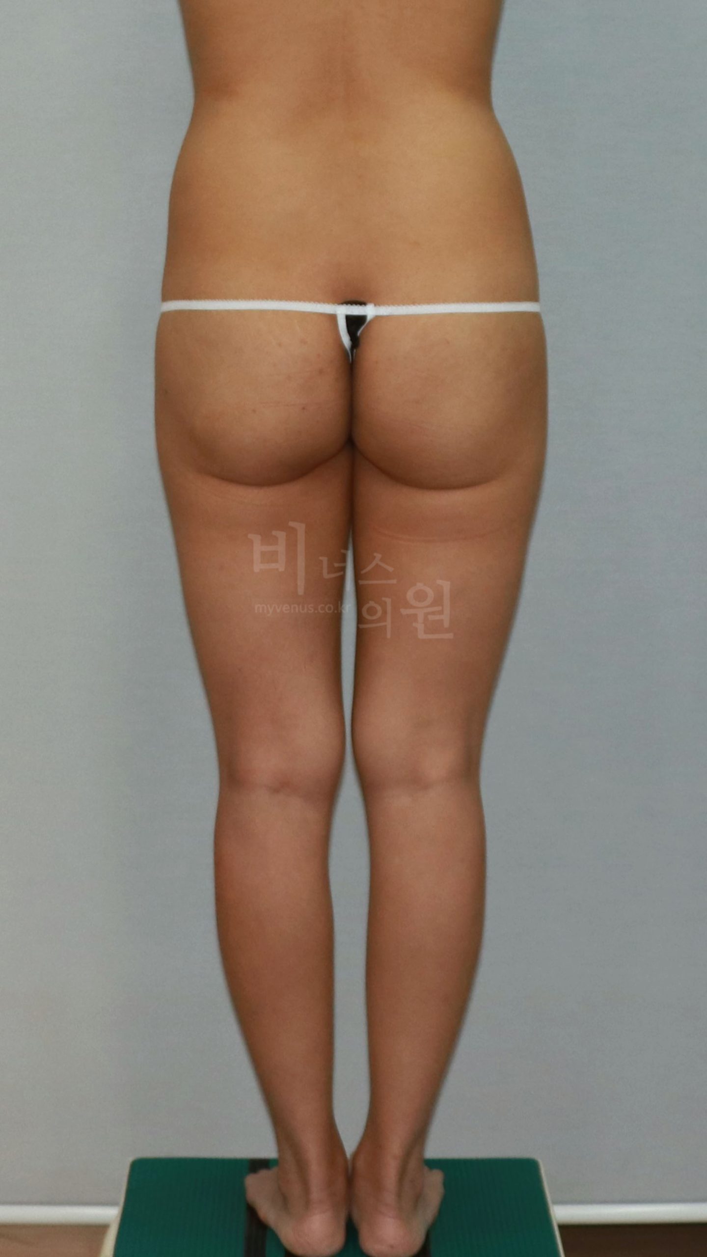 엉덩이축소 수술 전 후면