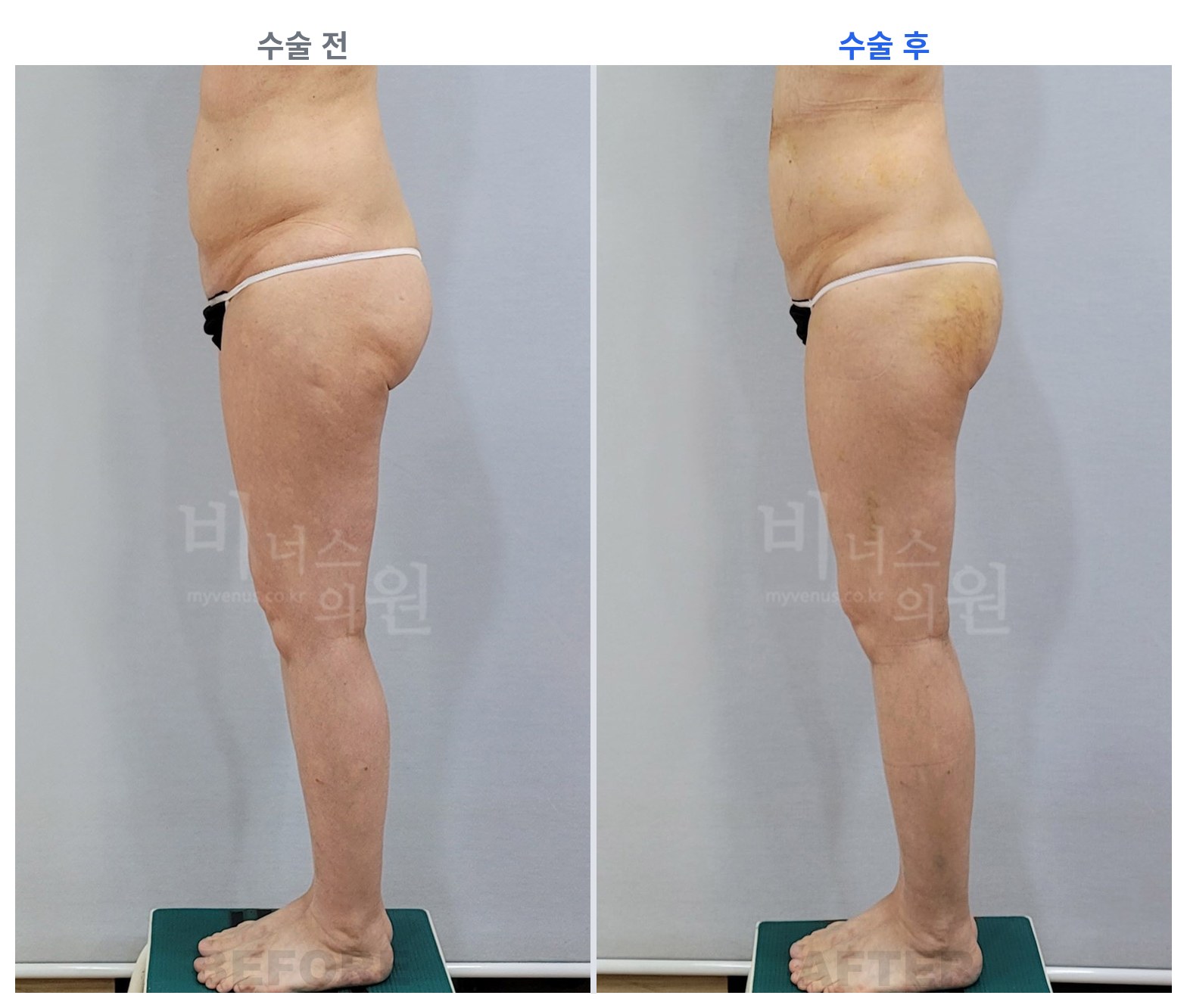 엉덩이축소 지방흡입 측면 수술 전후 비교