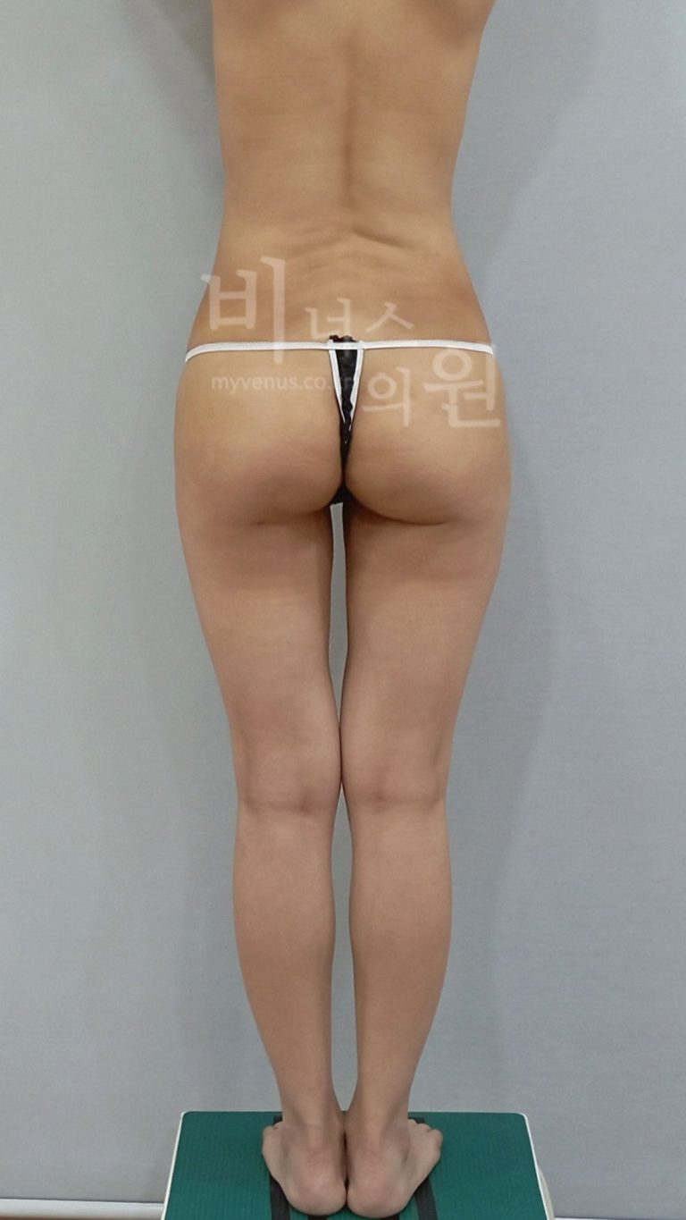 엉덩이축소 지방흡입 수술 후 후면 사진, 다리를 모은 자세