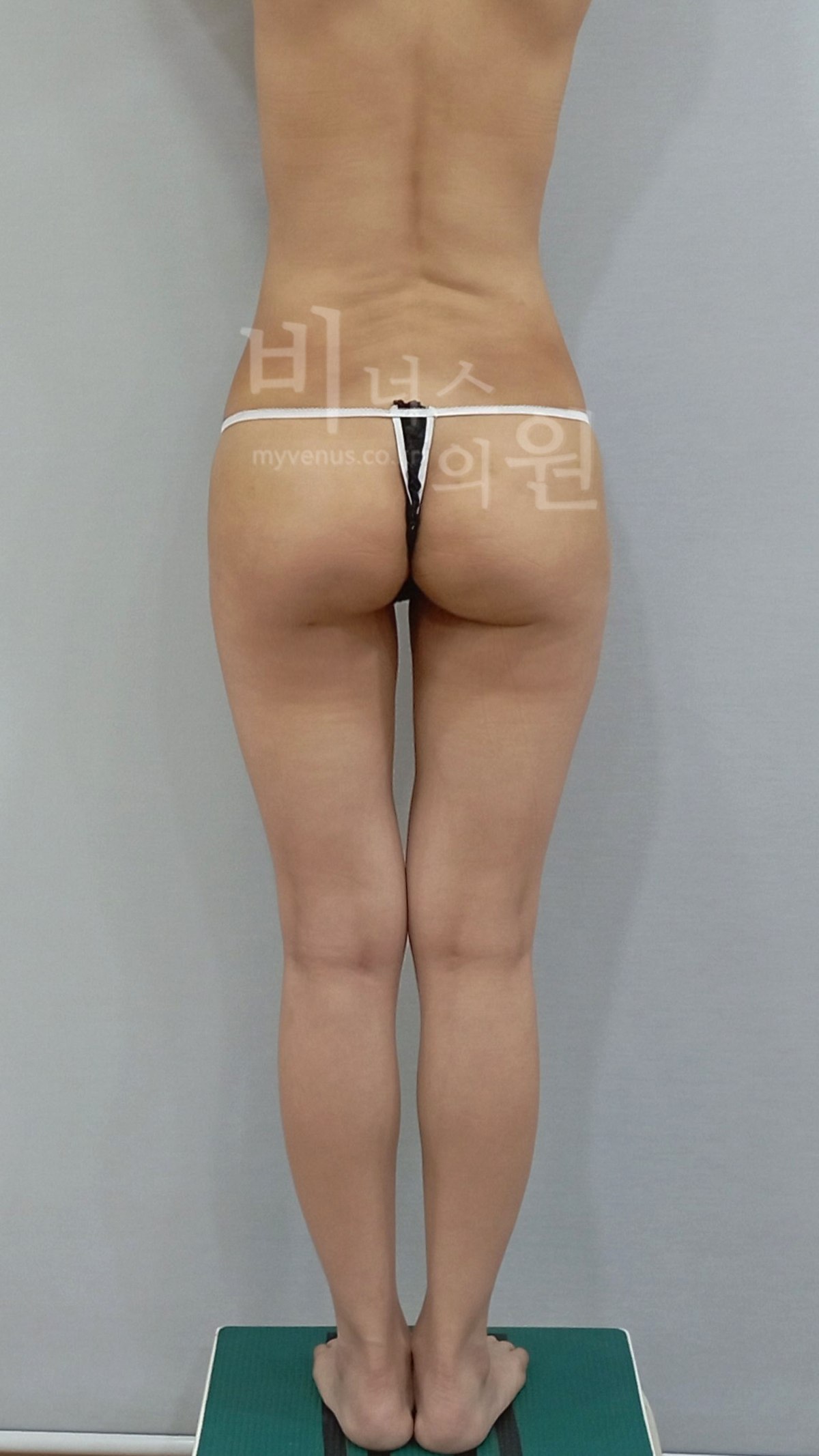 엉덩이축소 지방흡입 수술 후 후면 사진, 다리를 모은 자세