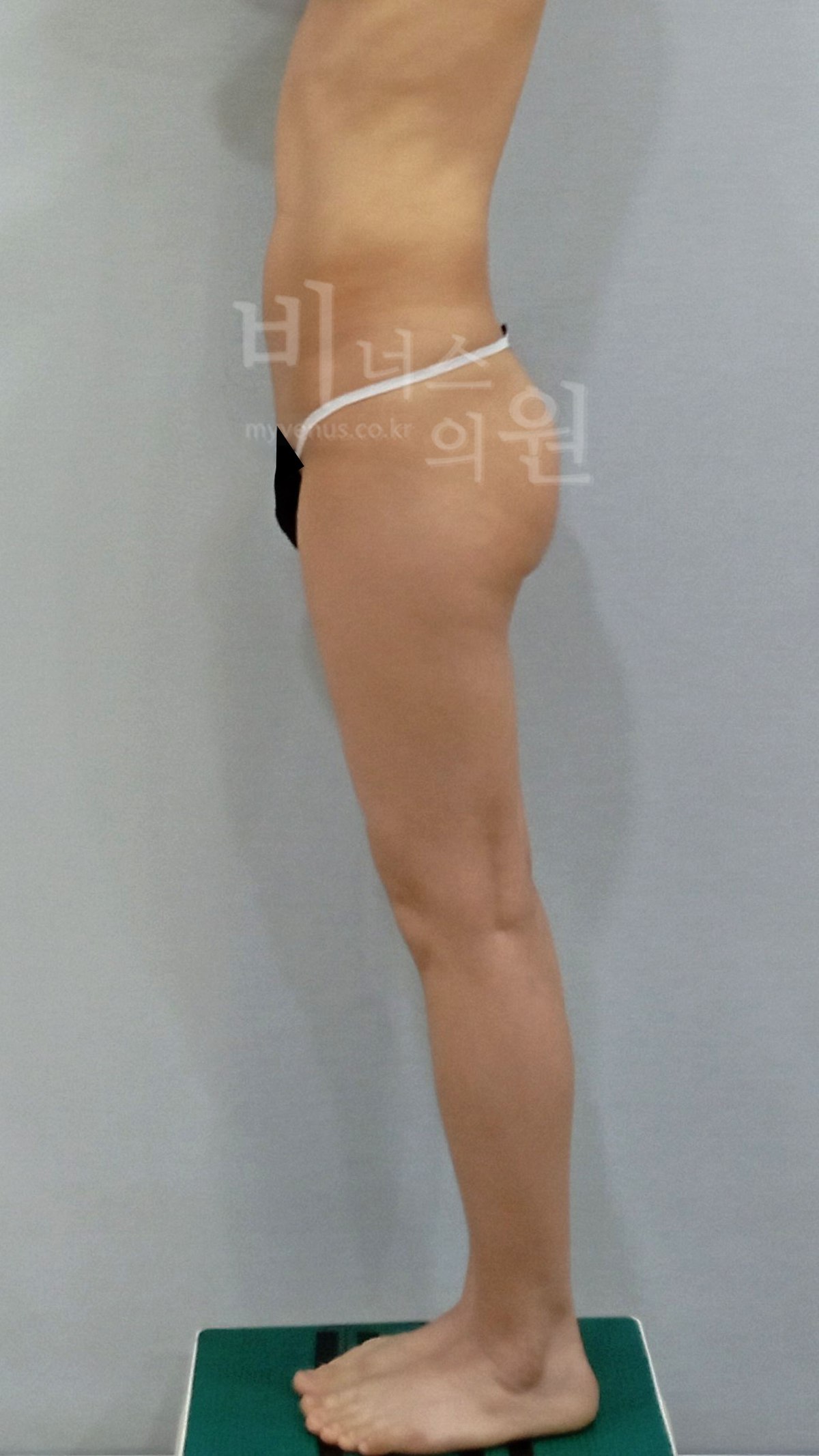 엉덩이축소 지방흡입 수술 전 측면 사진