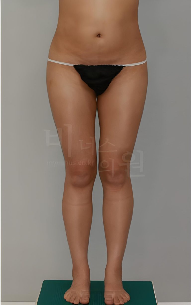 엉덩이축소 비용, 무엇으로 결정될까요? 상담 전 확인해야 할 병원 선택 기준