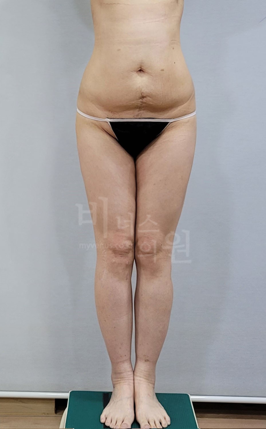 엉덩이축소 지방흡입 수술 전 정면 비너스의원
