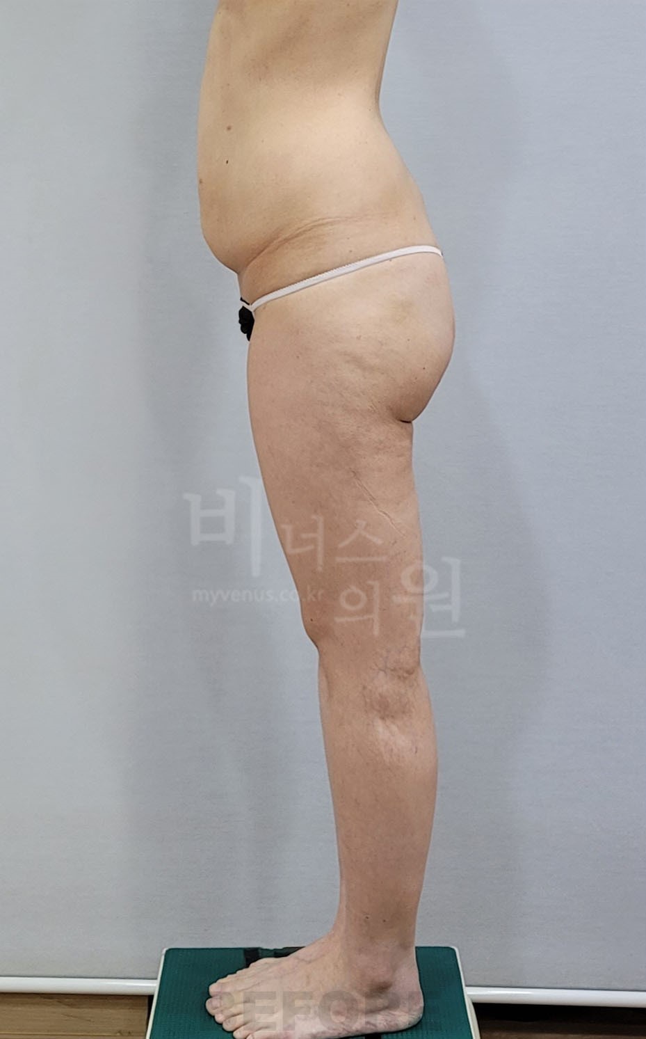엉덩이축소 지방흡입 수술 전 측면 ② 비너스의원