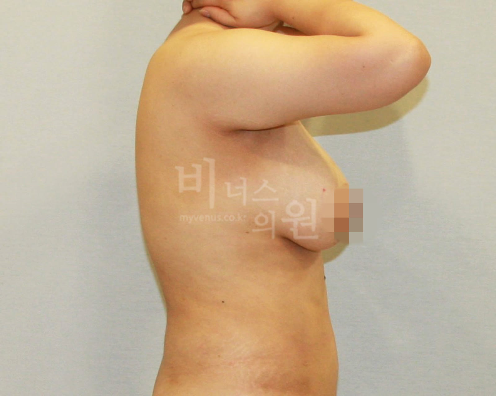 유방축소 지방흡입 수술 전 측면