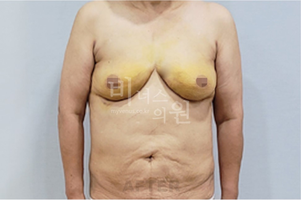 유방 부위 수술 후 정면(팔 내림)