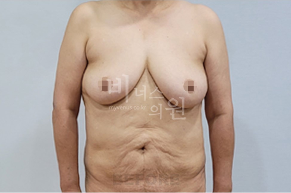 유방 부위 수술 전 정면(팔 내림)
