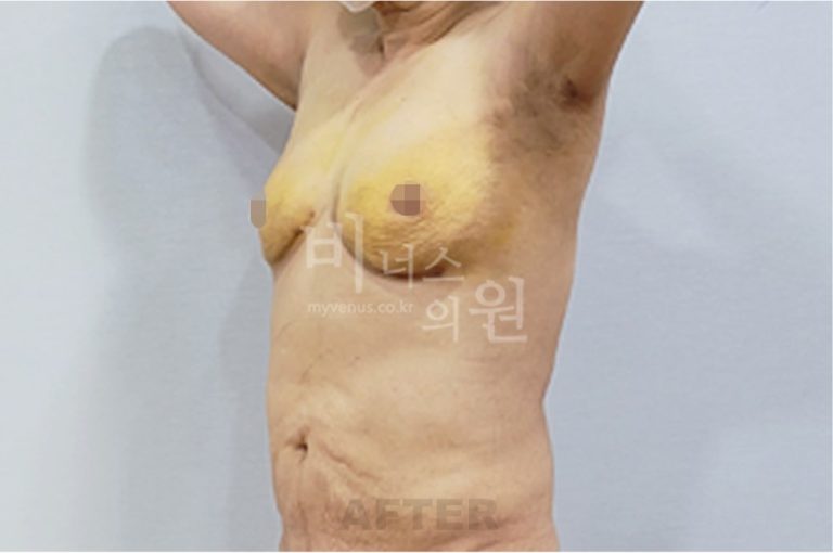 유방 부위 수술 후 우측면