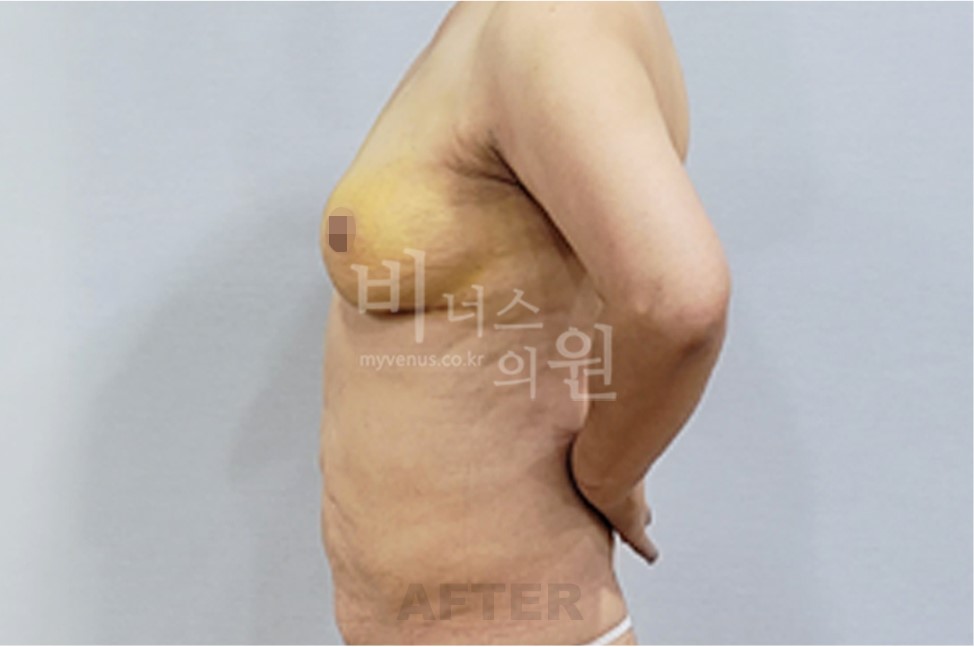 유방 부위 수술 후 좌측면
