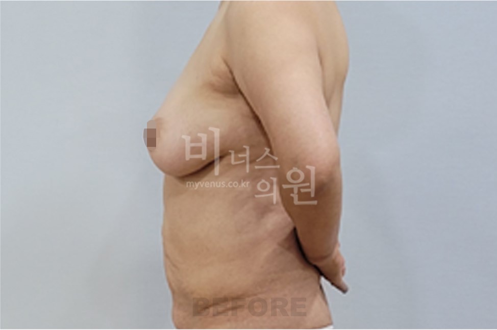 유방 부위 수술 전 좌측면