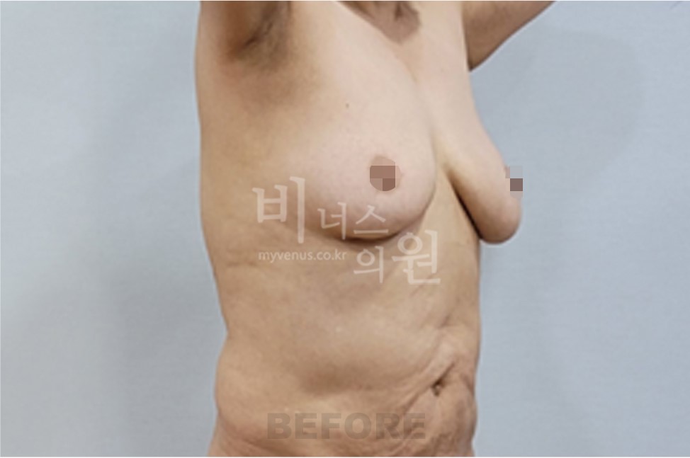 유방 부위 수술 전 우측 45도 측면