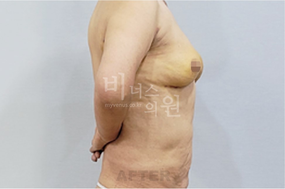 유방 부위 수술 후 좌측 45도 측면