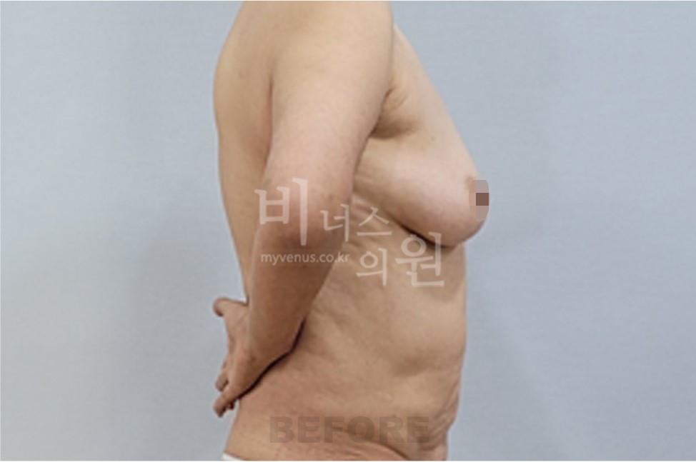 유방 부위 수술 전 좌측 45도 측면